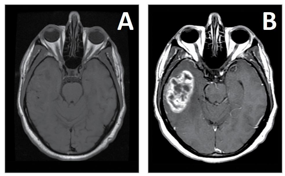 13 Figura 2. Ressonância nuclear magnética do cérebro de pacientes com glioblastoma (A) sem contraste e (B) com contraste (Omuro e DeAngelis, 2013). 1.2. Características anatomopatológicas dos glioblastomas Macroscopicamente, os glioblastomas são pouco delineados.