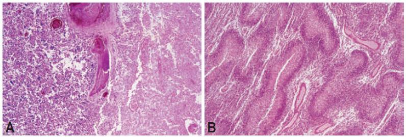 16 Figura 3. Histologia dos glioblastomas. (A) área de necrose (à direita) com alguns vasos tumorais apresentando trombose. (B) múltiplas áreas de necrose com pseudopaliçada (Kleihues e cols., 2007).