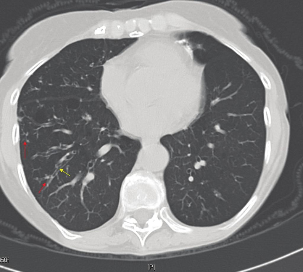 36 Opacidade com aspecto de árvore em brotamento (setas vermelhas) e bronquiectasia (seta amarela) compatível com