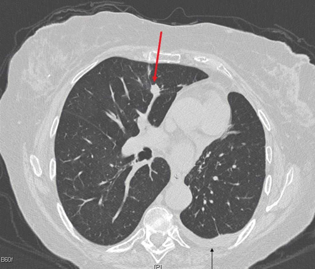 44 Nódulo pulmonar solitário à direita (seta vermelha) com padrão espiculado