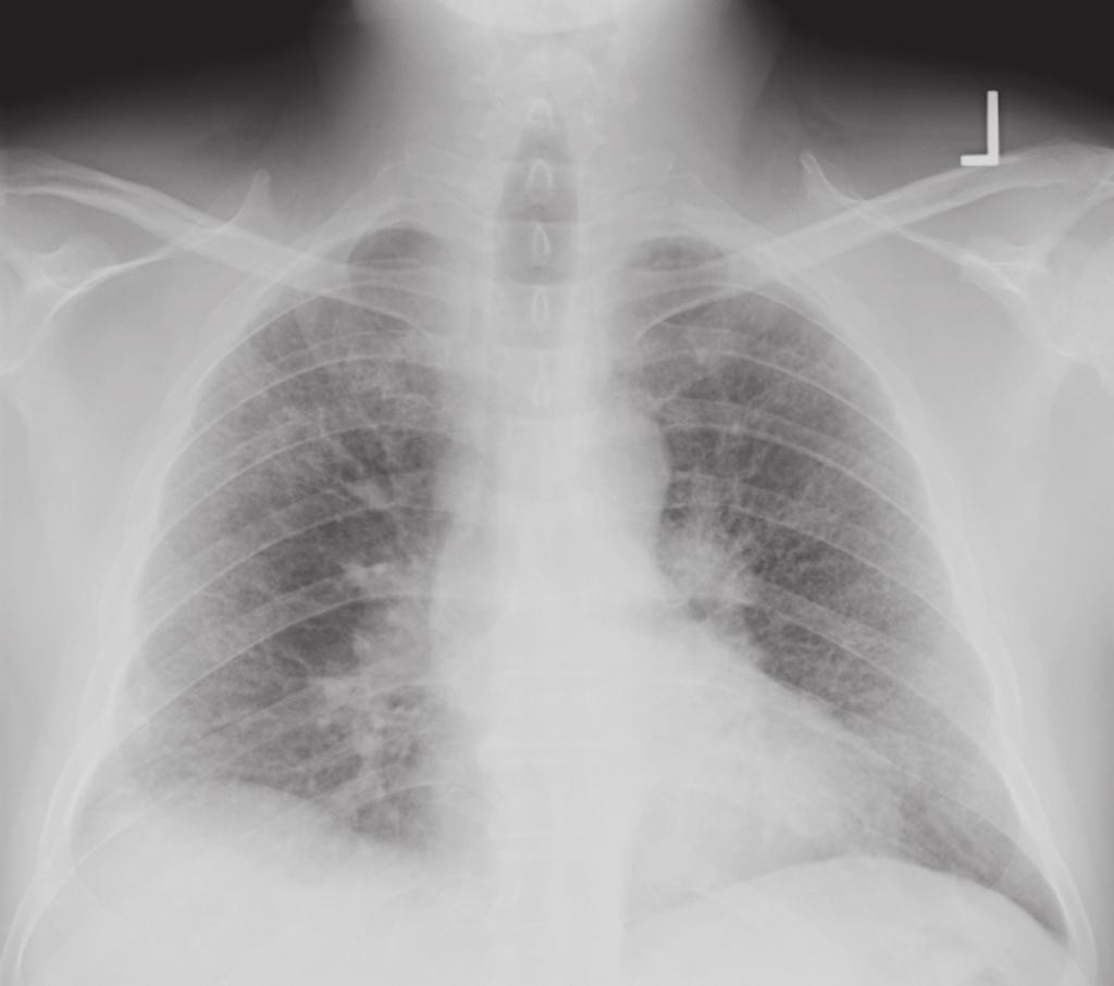 Observar as linhas B de Kerley (seta preta) e o manguito perivascular (seta amarela), assim como a congestão vascular pulmonar