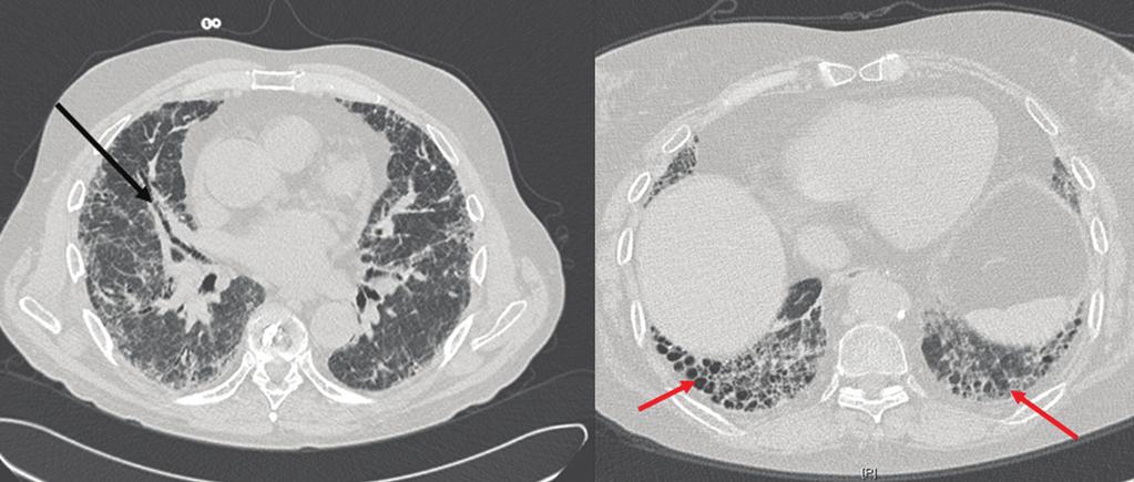 19 O RXT demonstra opacidades nodulares reticulares bilaterais com volumes pulmonares pequenos compatíveis com pneumonite