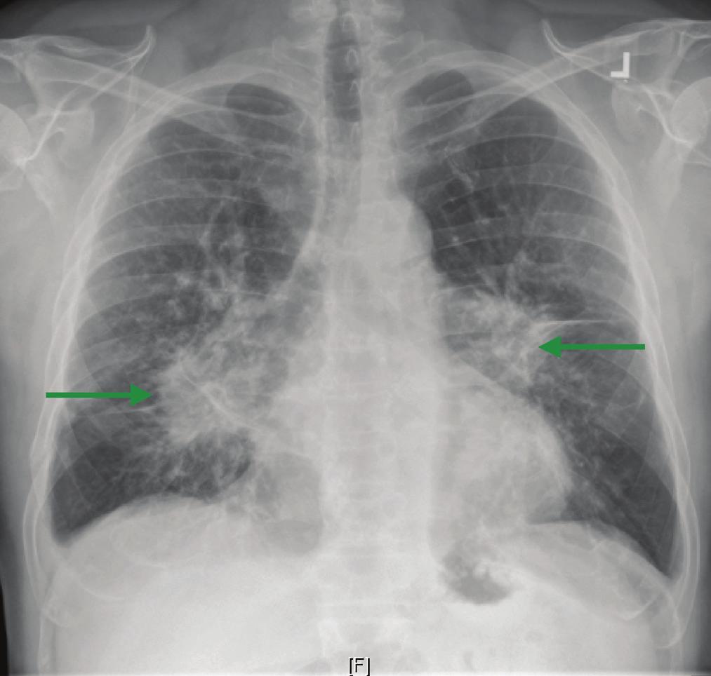 21 (A) Radiografia de tórax em PA observe