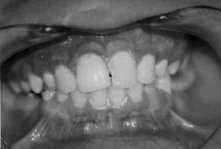 O dente, ao exame clínico, revelou anatomia coronária diferenciada com a presença de uma coroa bífida, na qual estava presente um sulco central que partia da junção cemento-esmalte, atravessava a