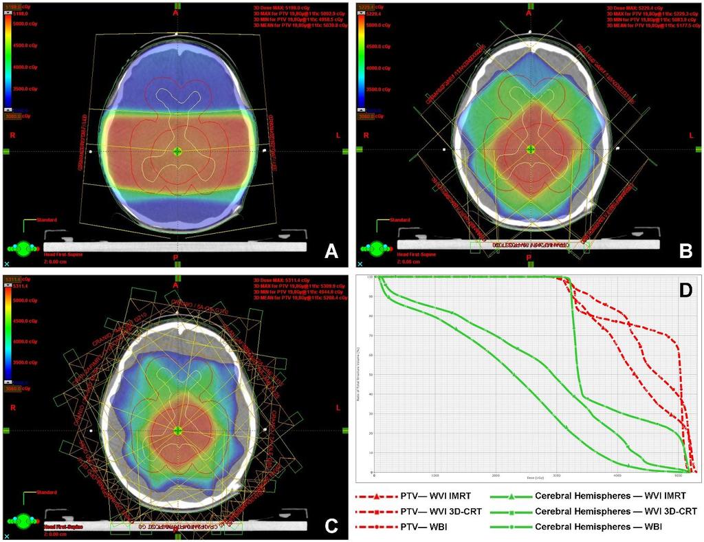 Irradiação do Sistema Ventricular Aspectos técnicos & Impacto dosimétrico RT convencional RT