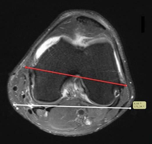 lidade ou soltura precoce do implante (1 10). Vários estudos demonstraram consequências desastrosas no posicionamento do componente femoral em rotação interna.