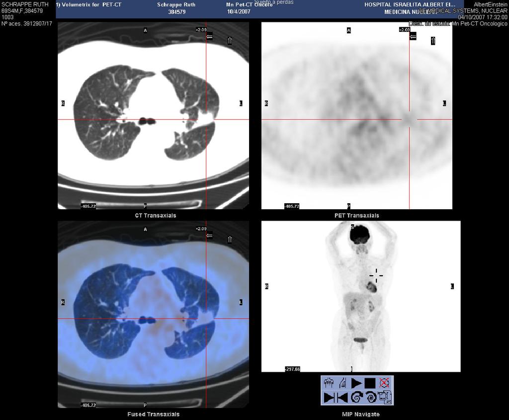 Planejamento conformado Delineação de alvos: PET-CT 18-FDG PET-CT para estadiamento de CNPCP: Sensibilidade: >90%