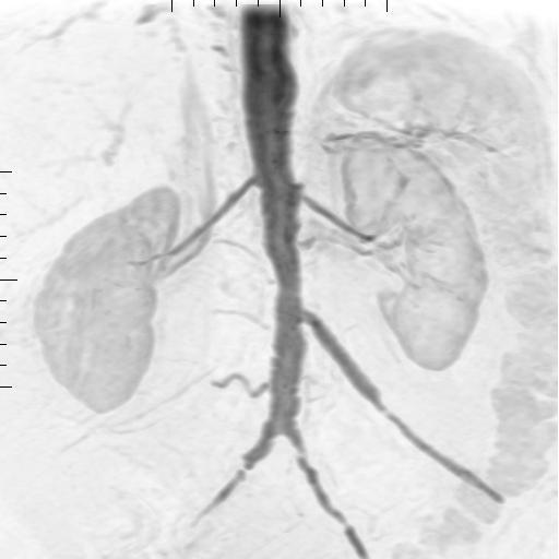 Arm Artéria Renal PARÂMETROS Arm Artéria Renal Flip angle: 45 graus; TR: Min ; TE: Min; Plano: Obliquo FOV: 42 cm; 38 cortes; Espessura: 2.