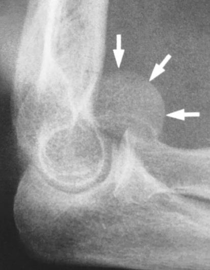 74) A imagem abaixo representa a fratura do capitelo do tipo a) HAHN-LORENZ. b) KOCHER-LORENZ. c) HAHN-STEINTHAL. d) KOCHER-STEINTHAL. Rockwood C.A. et al. Fractures. Philadelphia: Lippincott. 6 a ed.