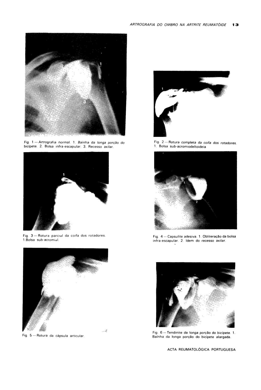 ARTROGRAFIA DO OMBRO NA ARTRITE REUMATÓIDE 13 # Fig. 1 Artrografia normal. 1. Bainha da íonga porção do bicipete. 2. Bolsa infra-escapular, 3. Recesso axilar. Fig. 2 Rotura completa da coifa dos rotadores.