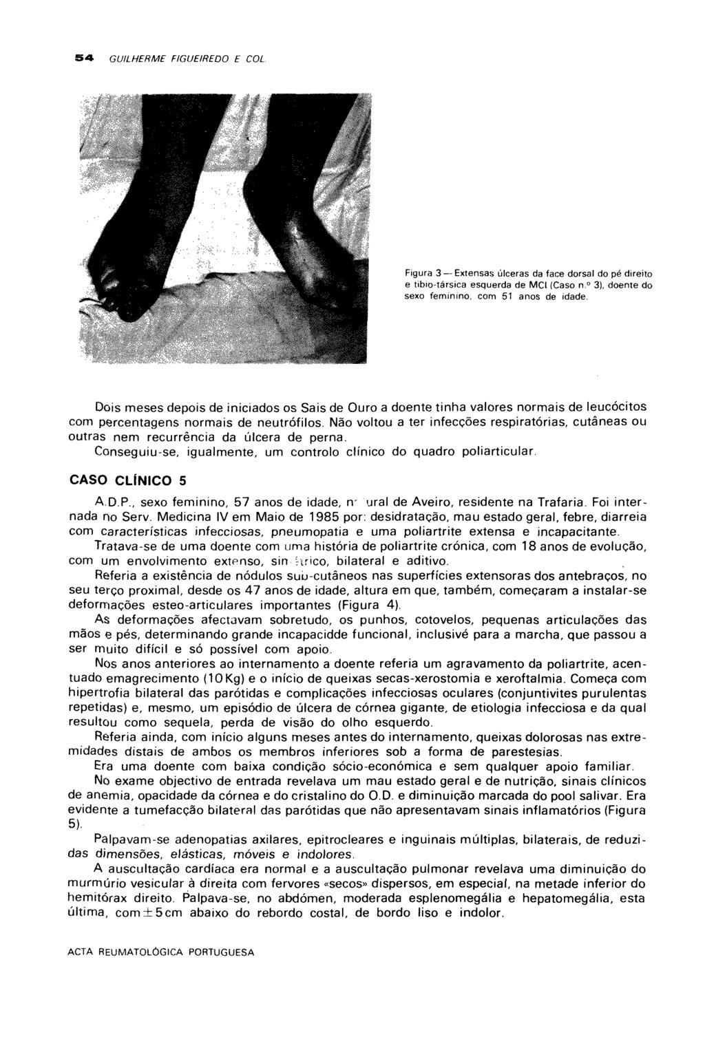 S» GUILHERME FIGUEIREDO E COL Figura 3 Extensas úlceras da face dorsal do pé direito e tibio-társica esquerda de MCI (Caso n. 0 3), doente do sexo feminino, com 51 anos de idade.