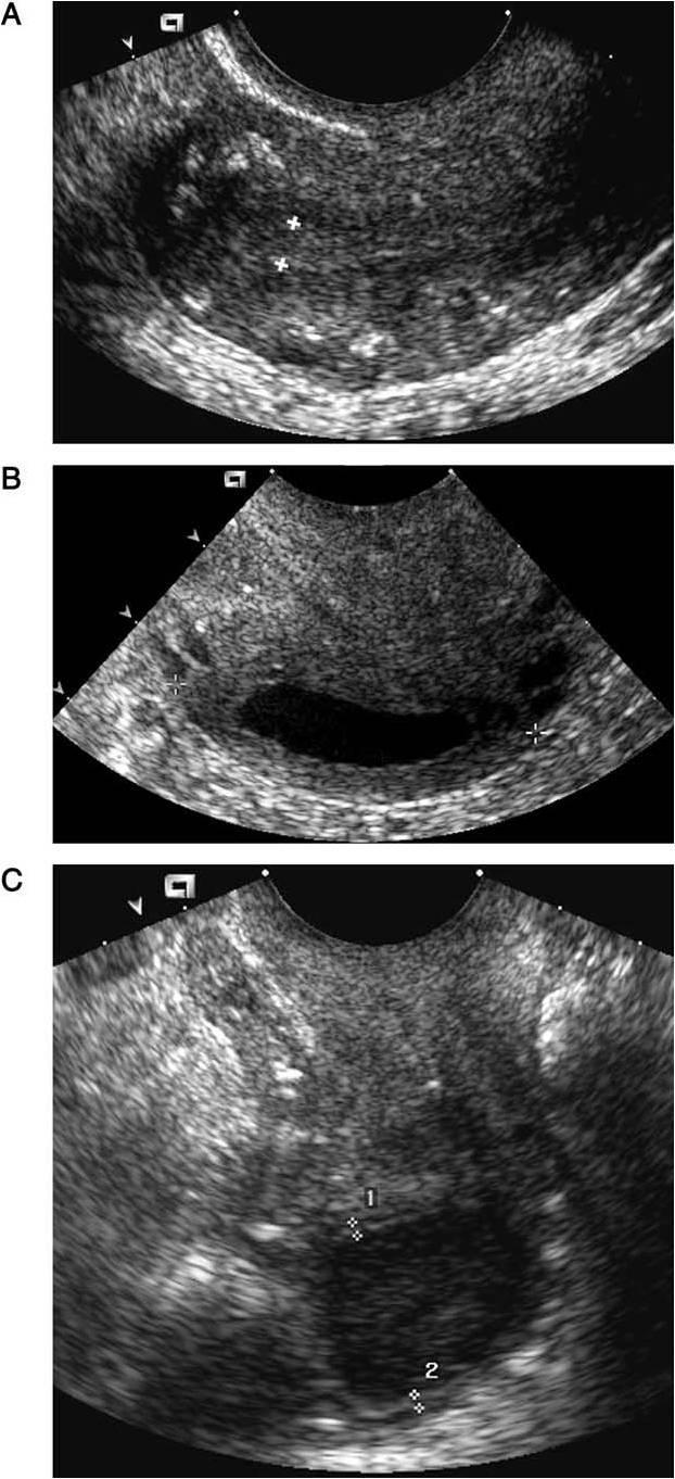 19 É fundamental visualizar a totalidade do endométrio, desde o canal cervical até o fundo uterino, incluindo as regiões cornuais para garantir-se que a região mais espessa está sendo avaliada 2.