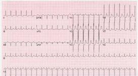 (&,%J+ Ondas P invertidas / inseridas no QRS QRS