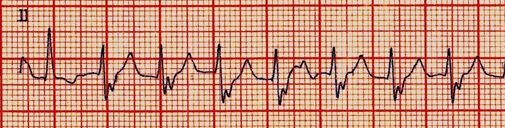 ELEMENTOS DE ARRITMIA VENTRICULAR VENTRICULAR TACHYCARDIA FEATURES Dissociação