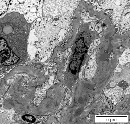 Microscopia eletrónica (glutaraldeído) - nem sempre necessário, no entanto, principalmente em biópsias