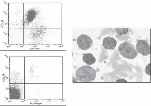 29 Cinética celular Tabela 2 b Aneuploidia 9 Burkitt Manto Imunocitoma CD19/CD10 CD19/CD5 CD19/CD38 Ig Diploidia 100% %