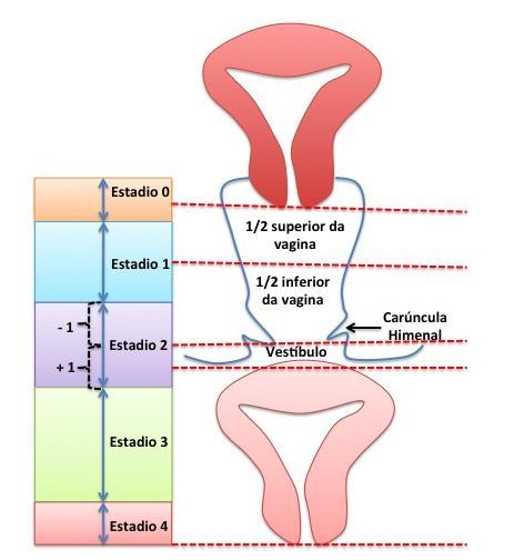 IV refere-se a medidas maiores e iguais à + (CVT-2). O estadiamento é realizado em cada compartimento (anterior, apical e posterior) da vagina, como se pode ver na figura 3. Figura 3.