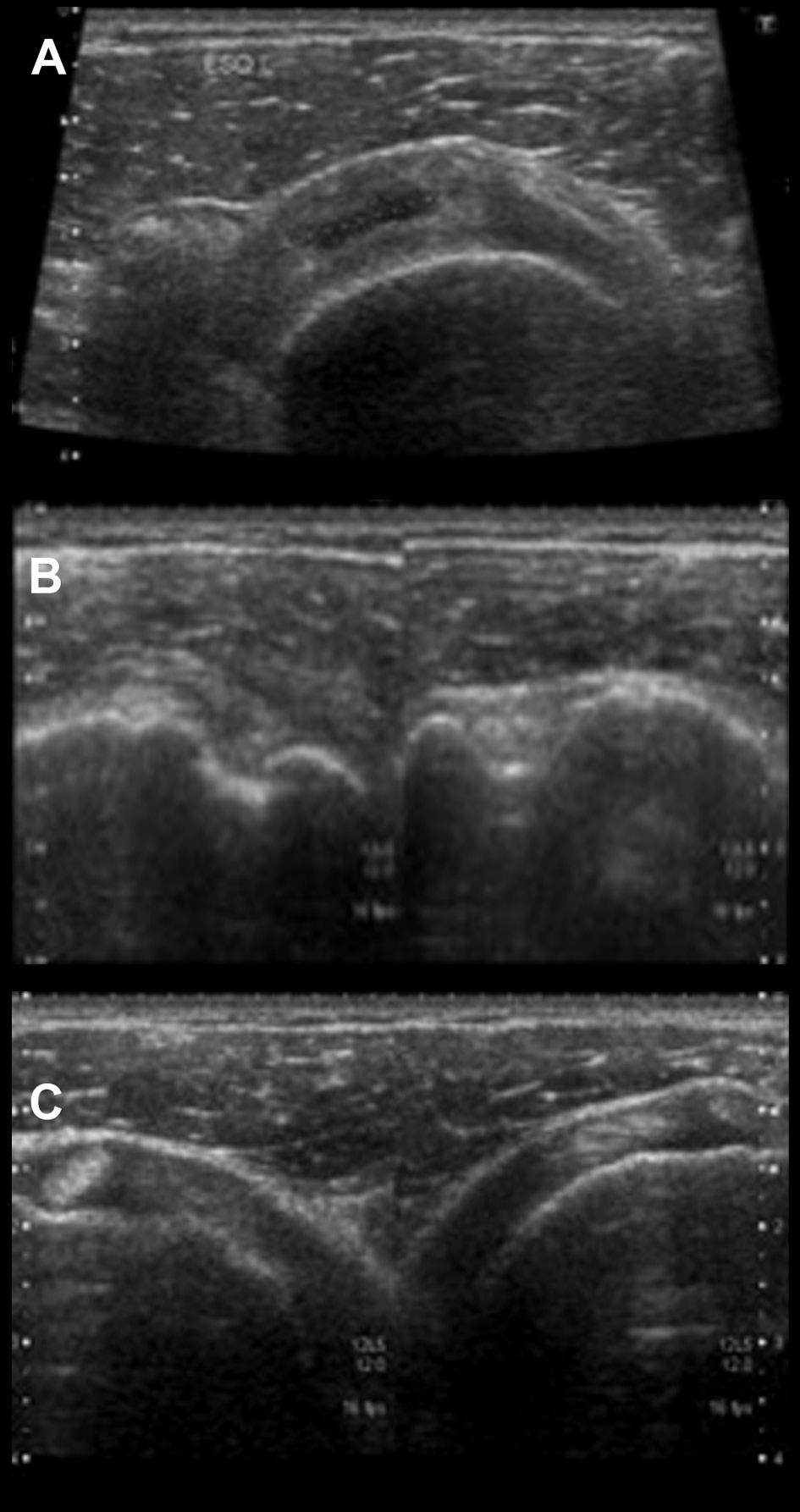 Revista Portuguesa de Ortopedia e Traumatologia Portuguese Journal of Orthopaedics and Traumatology 51 (IBM SPSS Statistics, Chicago, Illinois).