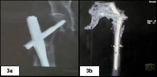 Figura 3 Imagens da haste intramedular implantada no fêmur da paciente. a) Imagem por Raios-X antes da fratura da haste.