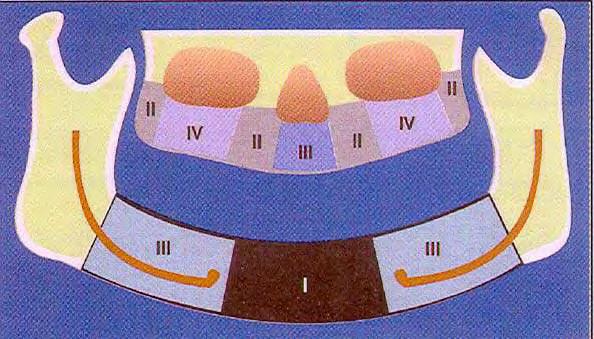 A densidade óssea da região posterior da maxila diminui rapidamente com a idade e, em média, é a menos densa dentre todas as regiões dos maxilares (MISCH 30,