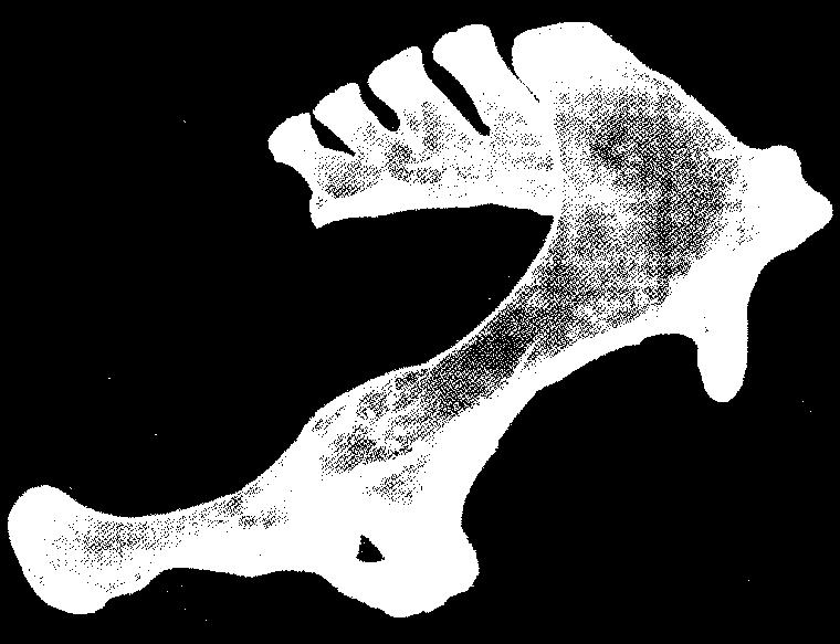 Osso Coxal e Sacro (Vista Lateral Direita) Espinhas Sacrais Tuberosidade Sacral Crista Ilíaca Linha Glútea Forames Sacrais Dorsais Incisura Isquiática