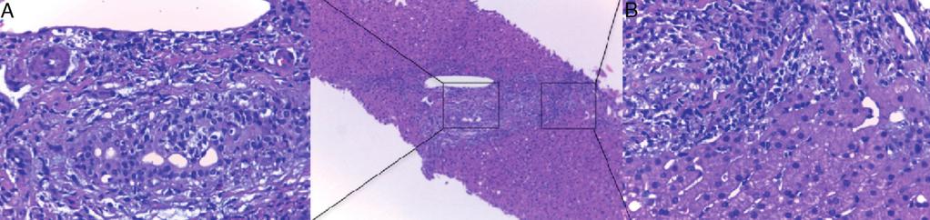 Ecografia/TC - ectasia das vias biliares + + Colangiografia - colangite esclerosante NE ND NE CPRE + ColangioRM Histologia hepática Lesão dos ductos biliares ND Inflamação - linfócitos + +