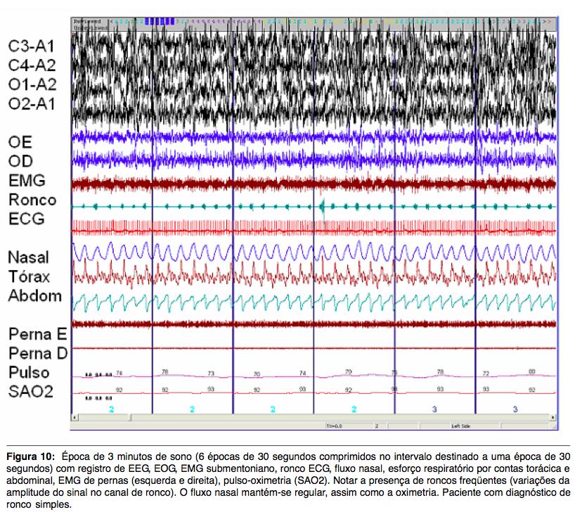 A figura abaixo mostra o registro simultâneo de diversos elementos 25 polissonográficos. Fonte: Bustamante (2006) 69.
