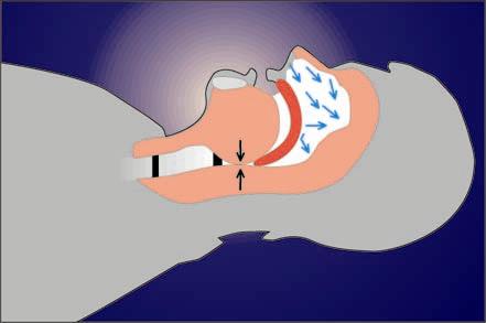 Capítulo 3. Conceitos sobre fisiologia do sono 22 Figura 15 Obstrução parcial da passagem de ar durante o ronco.