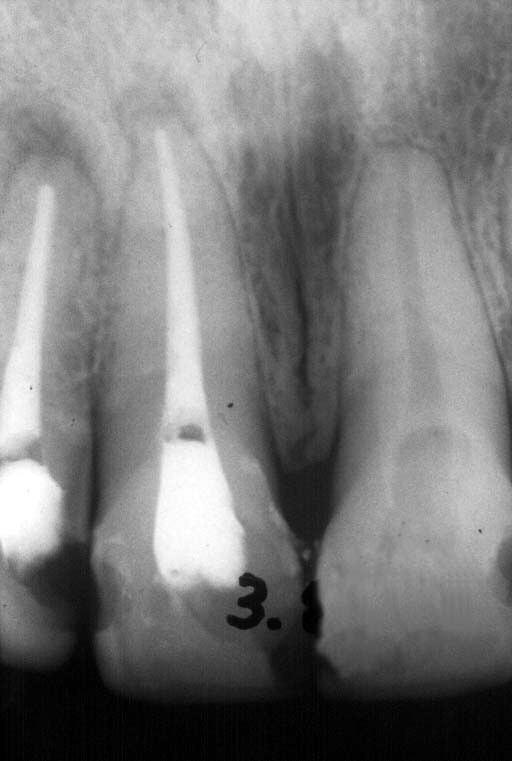 Figura. 3: Radiografia pré-operatória escolha mais apropriada para cada situação. QUANDO LIMPAR O FORAME? Como foi dito, a limpeza de forame já encontra grande aceitação nos casos de lesão periapical.