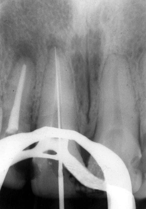 Observe que O canal do dente vizinho também foi tratado Figura 6: Radiografia de controle cinco anos após a conclusão do tratamento. Observe o desaparecimento da lesão periapical.