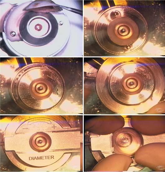 MALKS : especificações e desenvolvimento 153 A Figura 5A mostra como a câmara anterior artificial era preenchida, para aferição pré-operatória da PIC com tonômetro de Barraquer.