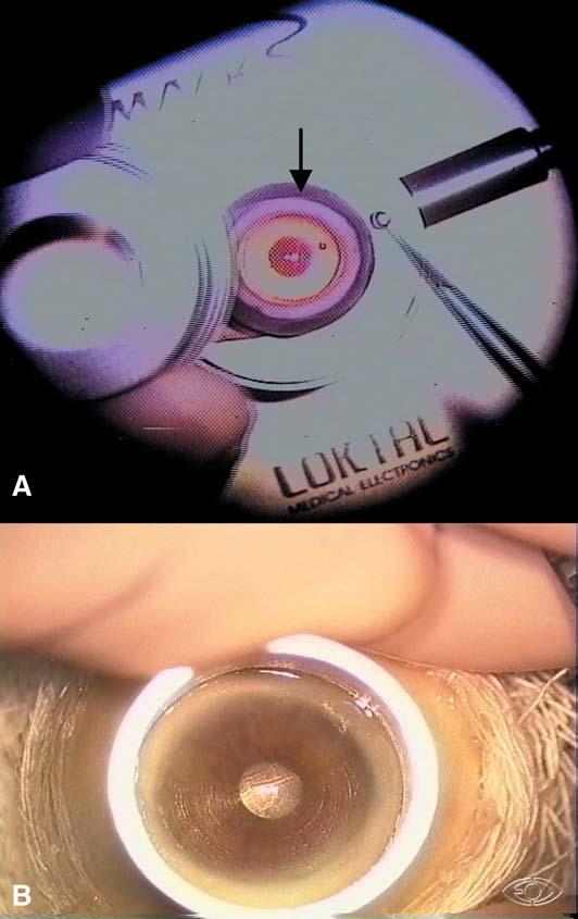 A C B D DISCUSSÃO O desenvolvimento da câmara anterior artificial possibilitou aos cirurgiões obterem lamelas corneanas a partir de botões córneo-esclerais de Banco de Olhos sem a necessidade de