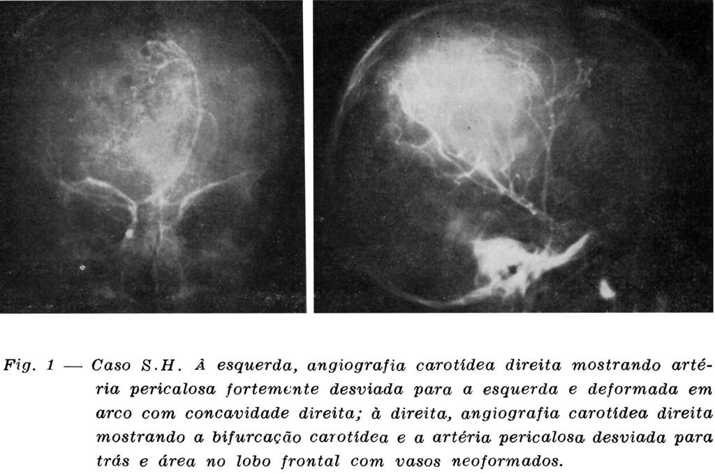 OBSERVAÇA O S.H., de sexo feminino, com 6 anos de idade, branca, registro n. 9686, foi hospitalizada em 03-07-1971 com queixas de cefaléias e vômitos iniciados há 30 dias.