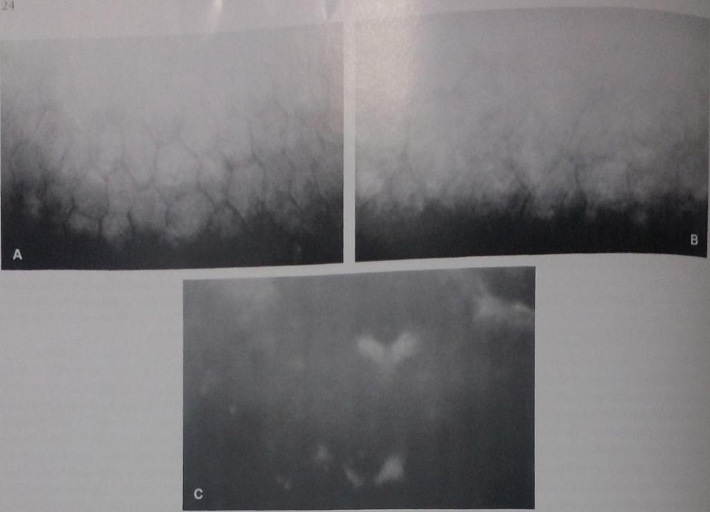 A realização da microscopia especular, na presença de edema de córnea, só é viável com equipamento de contato, para tanto, é importante que durante o exame se procure, ao deslizar a lente objetiva