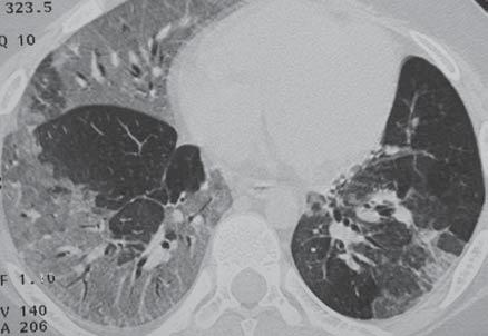 Associação de bronquiolite obliterante pós-infecciosa e hemossiderose pulmonar na infância 589 cas do lobo superior esquerdo e segmento superior do lobo inferior esquerdo (Figura 1).