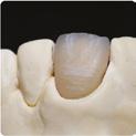 Tendo também apossibilidade de neutralizar estes efeitos fazendo uso do IS 9 misturando com as outras massas de efeito incisal.