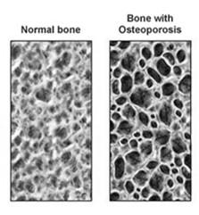 ) - Não forma osteóide - Aumenta formação osteomalacia ou raquitismo ( mineralização da matriz) inadequada mineralização do osteóide ( vit D / P) - Não mineralização - Reabsorve em excesso - Diminui