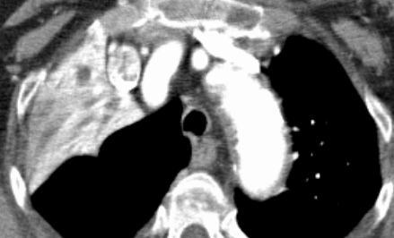 Diminuição da radiotransparência pulmonar na região peri-hilar, de forma simétrica, poupando a periferia e configurando o aspecto em asa de borboleta.