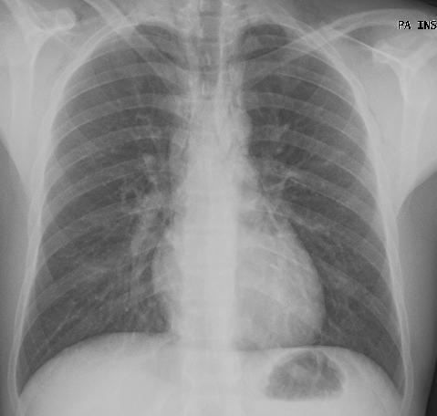 A Radiografia do tórax de frente mostrando alargamento do mediastino à direita, não fazendo contudo sinal de silhueta com o seu contorno (*) e estendendo-se para