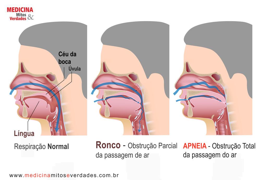 Insônia sintoma que dificultam o início ou manutenção do sono.