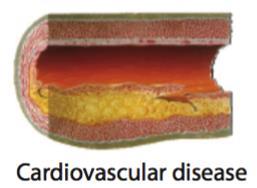 Principais Fatores de risco para progressão da fibrose hepática o Idade mais avançada o Diabetes o IMC >28Kg/m 2 o Consumo de álcool moderado a intenso:. 30g etanol/dia homem.