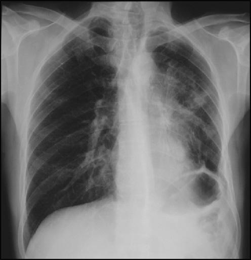 Aspergilose pulmonar necrotizante: a propósito de dois casos clínicos radiological findings, elevation of inflammatory markers and eith for Aspergillus or the isolation of Aspergillus from