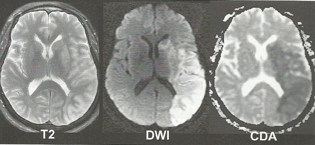 Ressonância magnética no AVCI Edema na fase