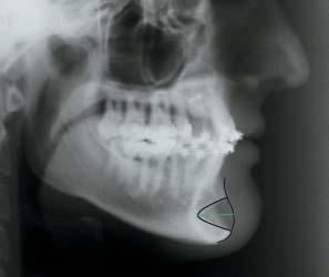 As medições foram realizadas manualmente pelo mesmo investigador utilizando folhas de papel acetato 0,07 mm com lapiseira de 0,5 mm, sendo repetidas por três vezes em cada telerradiografia e