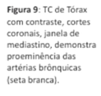 Caracterizaram-se ainda artérias brônquicas proeminentes ipsilaterais (Figura 9). DISCUSSÃO E CONCLUSÕES A atresia pulmonar unilateral é uma condição congênita rara.