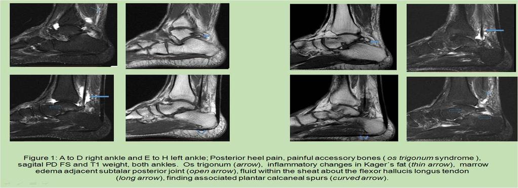 Findings in plantar surface (FIGS 17-21). Findings in medial region (FIG. 22).