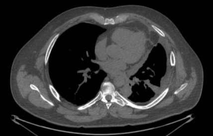 Caso Clínico Masculino, 57 anos, não tabagista. Mesotelioma pleural.