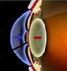 7 Aberrações ópticas nos processos da Acomodação e Presbiopia. Com o advento das lentes intraoculares, os primeiros modelos de desenho confeccionados foram os das lentes esféricas.