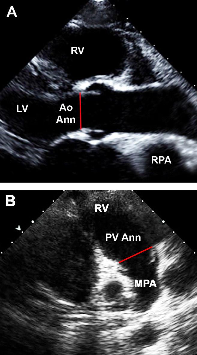 Continuação Função sistólica do VD Mesmo acima Mesmo acima Contração isovolumétrica no anel lateral tricúspide Doppler tecidual Apical 4-câmaras Tempo do pico da velocidade da contração