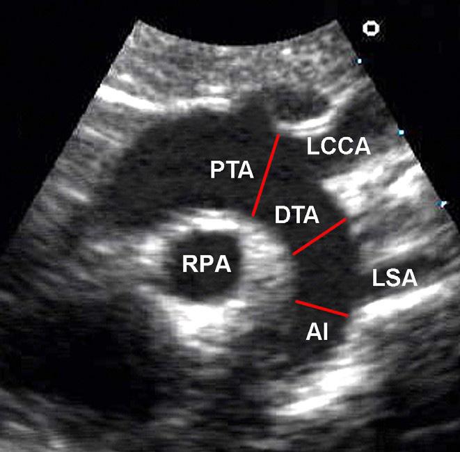 paraesternal em eixo curto; a coronária direita distal é mais bem medida no momento de máxima expansão no plano apical em 4 câmaras com angulação posterior; a descendente posterior é mais bem medida